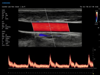 Common carotid artery, CFM & PW