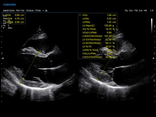 Heart (long axis of LV), B-mode + Assist