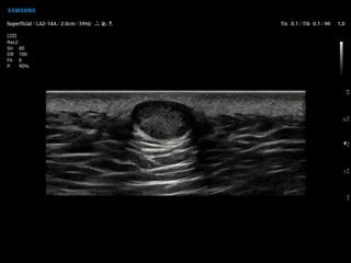 Lipoma, B-mode