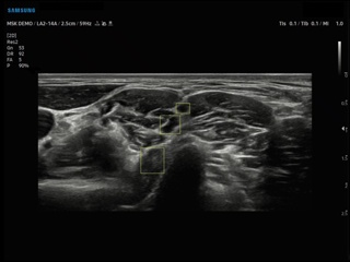 Brachial plexus, Nerve Track