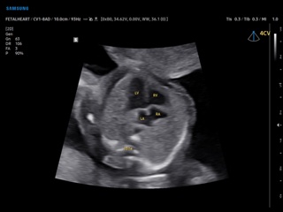 Fetal heart (4 chamber view), ViewAssist
