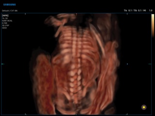 Fetal spine, CrystalVue