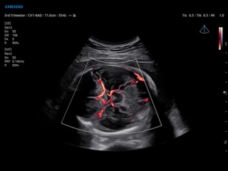 Fetal brain, MV-Flow