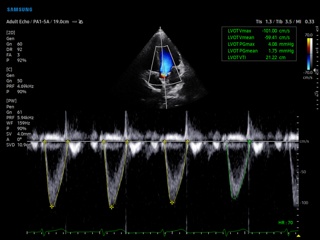 Left ventricular outflow tract, HeartAssist