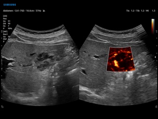 Liver hemangioma, MV-Flow