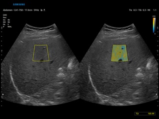 Hepatic steatosis, QUS (TAI+TSI)