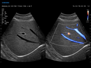 Hepatic vein, S-Flow