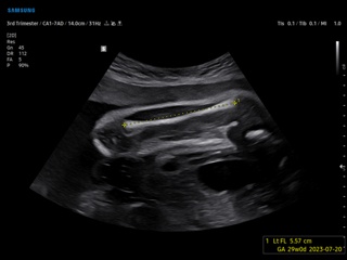 Fetal femur, ViewAssist