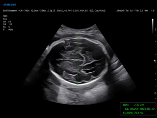Fetal brain, BiometryAssist