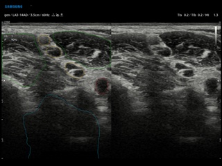 Brachial plexus, NerveTrack