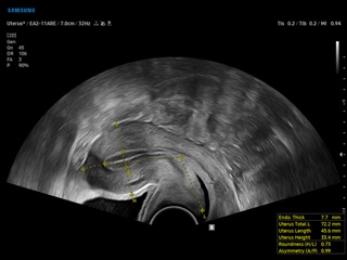 Uterus, UterineAssist