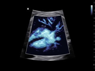 Fetal heart, MV-Flow™