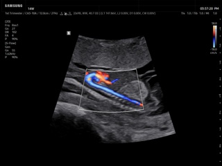 Fetal aorta, S-Flow™
