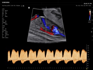 Fetal heart (ductus venosus), CFM & PW