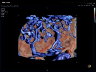 Placenta, CrystalVue & MV-Flow, 3D