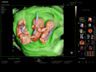Multiple pregnancy - triplets, EzVolume