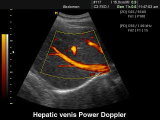 Hepatic veins, power doppler