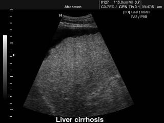 Liver cirrhosis, B-mode