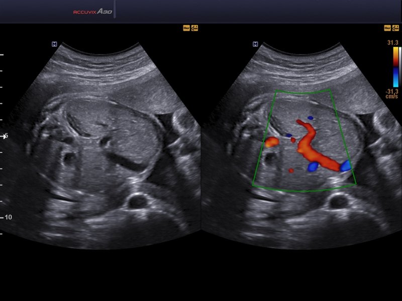 Живот плода, B-режим и ЦДК (эхограмма №568)