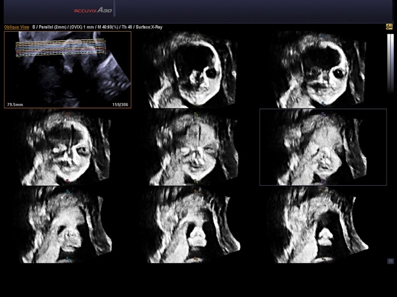 Лицо плода, Multi OVIX и 3D (эхограмма №569)