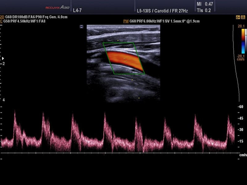 Общая сонная артерия, CFM и PW (эхограмма №590)