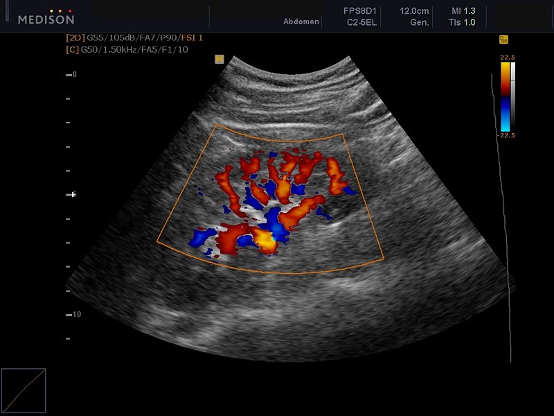 Почка, цветной допплер (эхограмма №603)