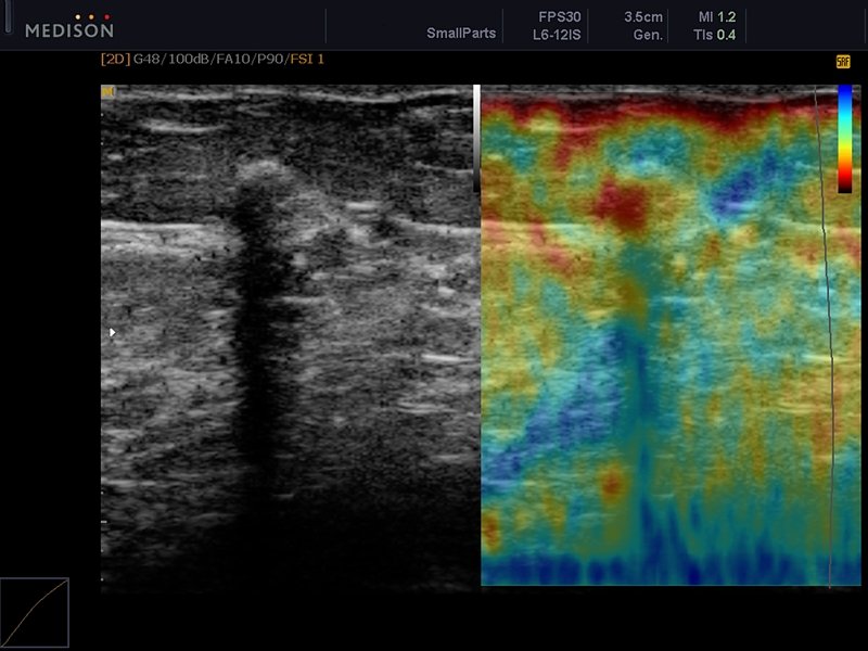 Молочная железа - кальцинированная олеогранулема, эластография (эхограмма №613)