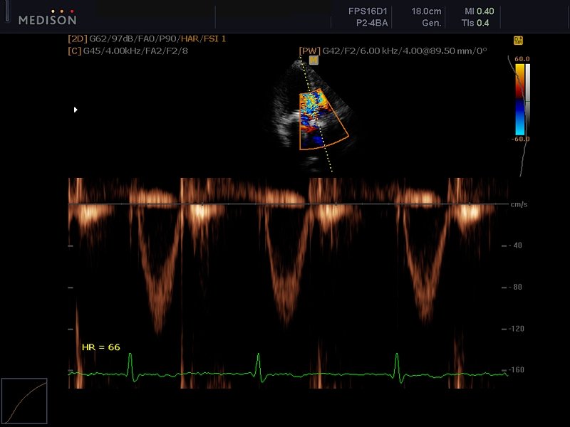 Аортальный клапан, CFM и PW (эхограмма №614)