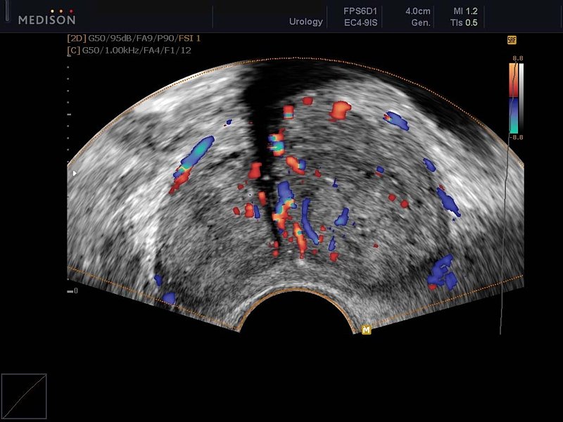 Предстательная железа, цветное картирование (эхограмма №616)