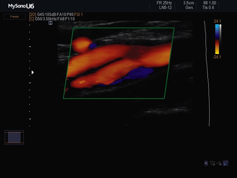 Общая сонная артерия - бифуркация, цветной допплер (эхограмма №619)