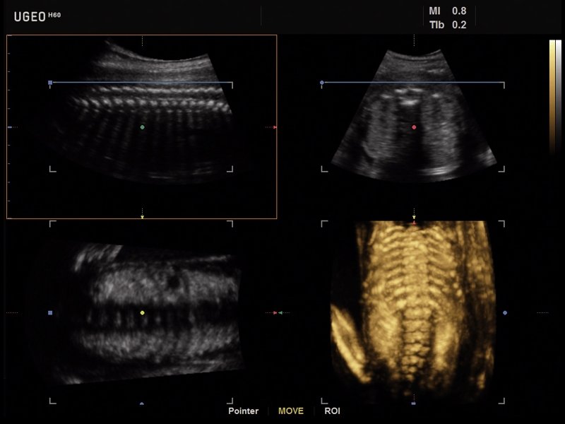 Позвоночник плода, MPR и 3D (эхограмма №628)