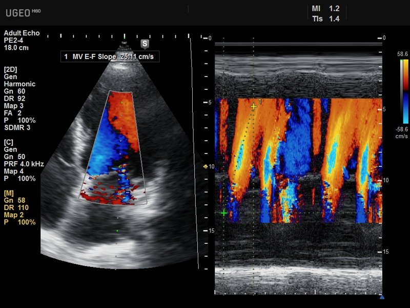 Сердце, цветной M-режим (эхограмма №639)