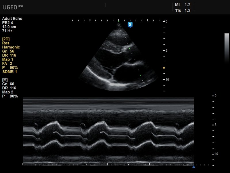 Сердце, M-режим (эхограмма №640)