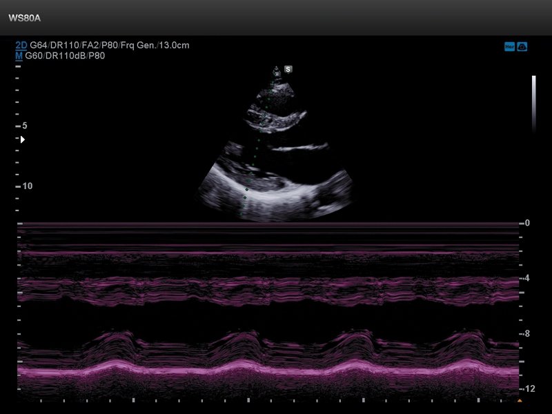 Сердце - левый желудочек, M-режим (эхограмма №667)
