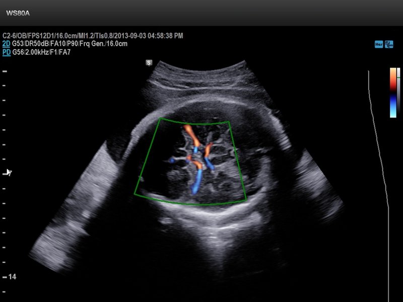 Плод - средняя мозговая артерия, S-Flow (эхограмма №668)