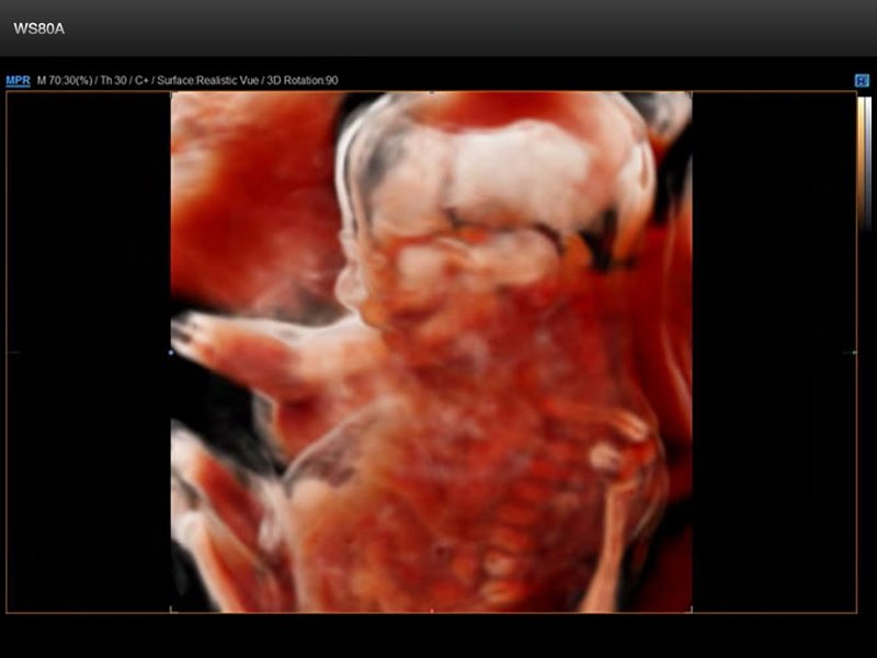 Плод - 21 неделя, Realistic Vue 3D (эхограмма №675)