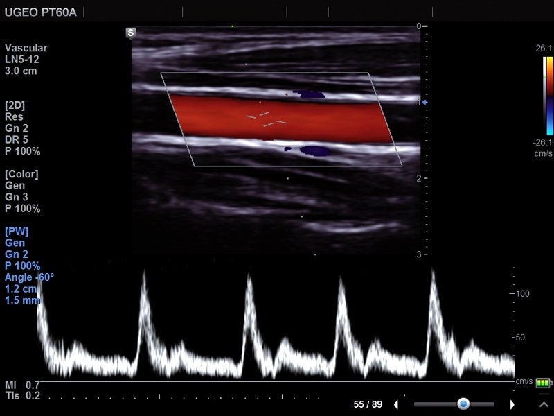 Общая сонная артерия, CFM и PW (эхограмма №676)