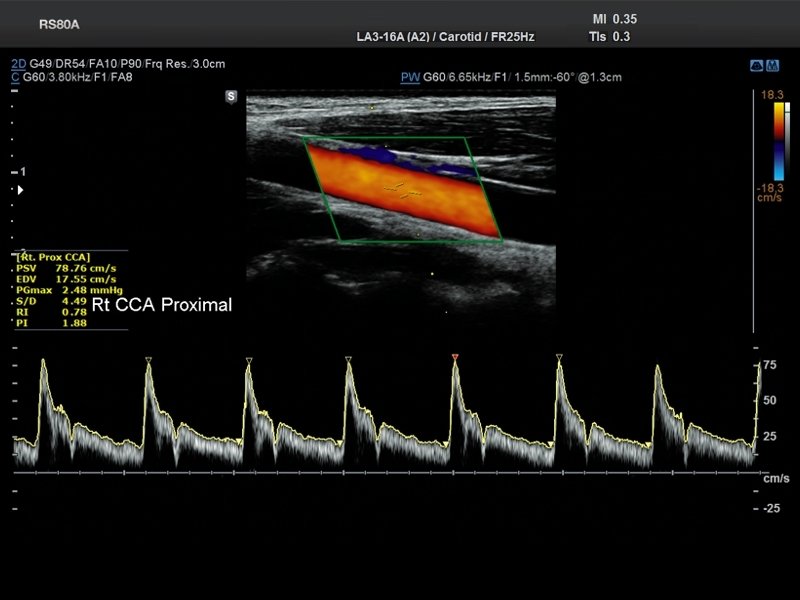 Общая сонная артерия, CFM и PW (эхограмма №686)