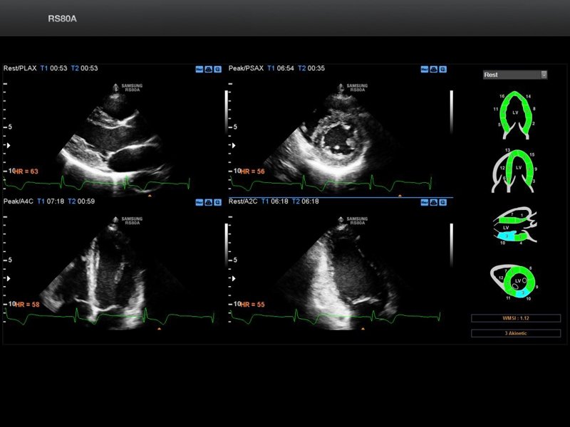 Сердце, Stress Echo (эхограмма №700)