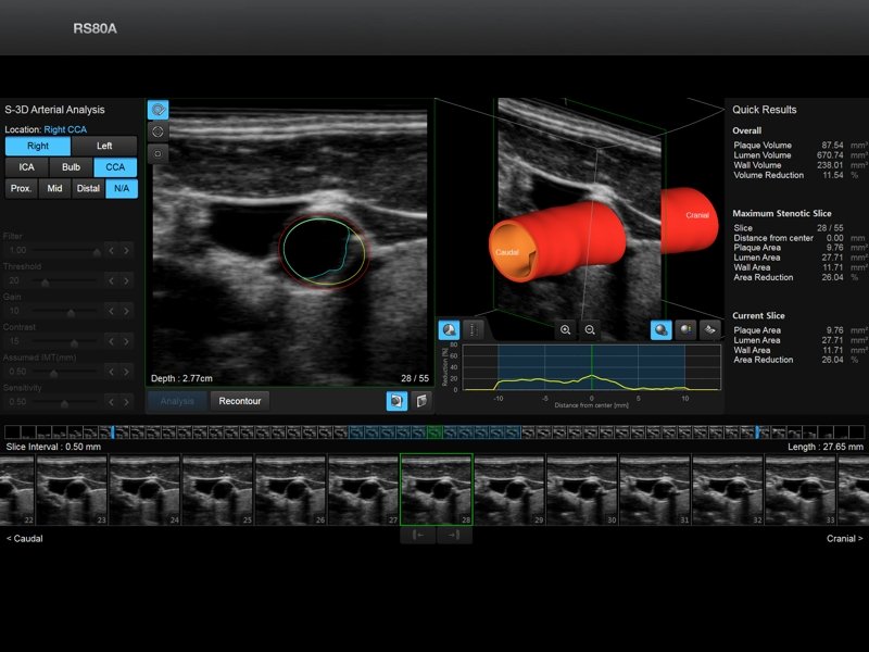 Общая сонная артерия, S-3D Arterial Analysis (эхограмма №701)