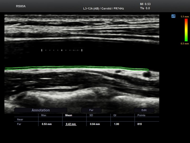 Общая сонная артерия, Auto IMT (эхограмма №702)