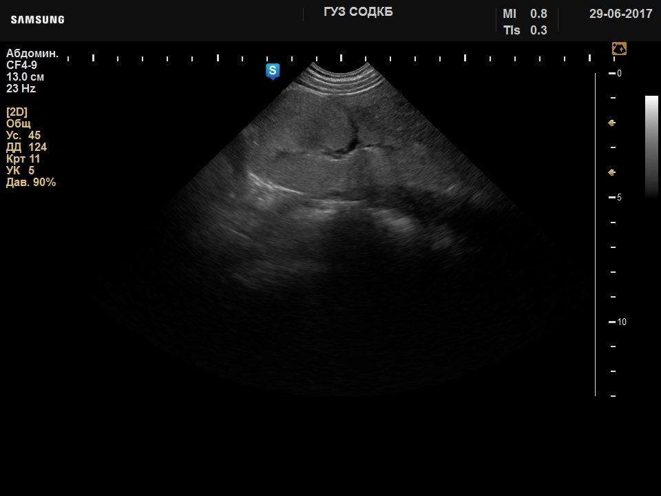 Почка - дисплазия почечной ткани, B-режим (эхограмма №734)