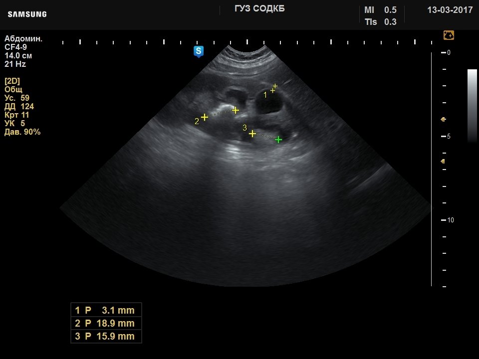 Почка - конкременты и расширение ЧЛС, B-режим (эхограмма №738)