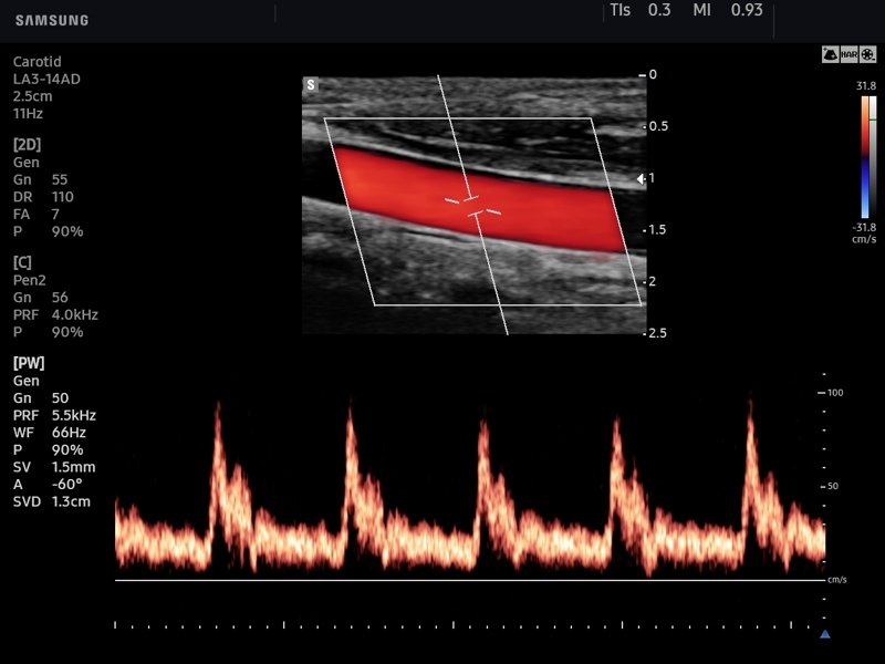 Общая сонная артерия, CFM и PW (эхограмма №746)