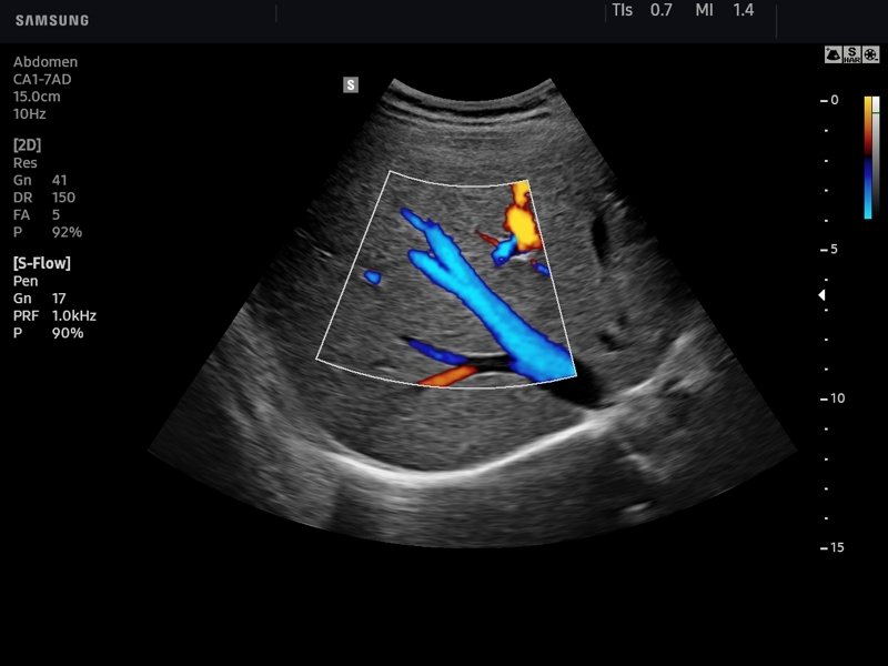 Печень, S-Flow (эхограмма №750)