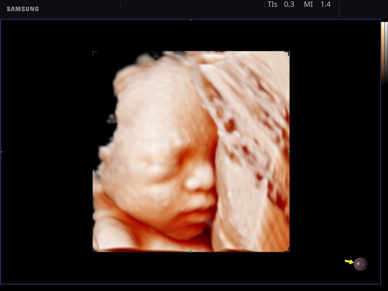 Плод - лицо, Realistic Vue, 3D (эхограмма №760)