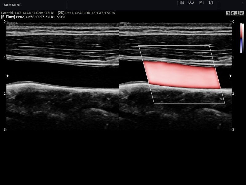 Общая сонная артерия, S-Flow™ (эхограмма №769)