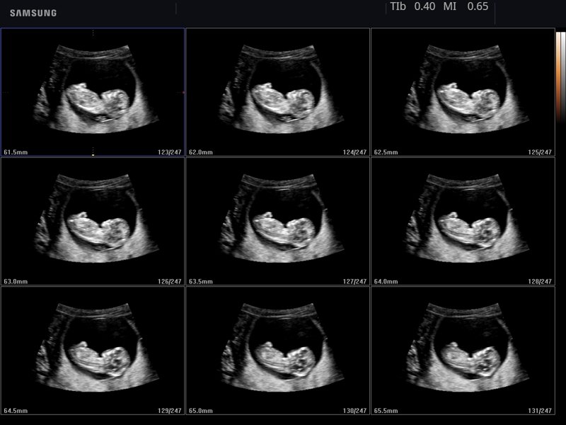 Плод - ранний срок беременности, MSV (эхограмма №776)