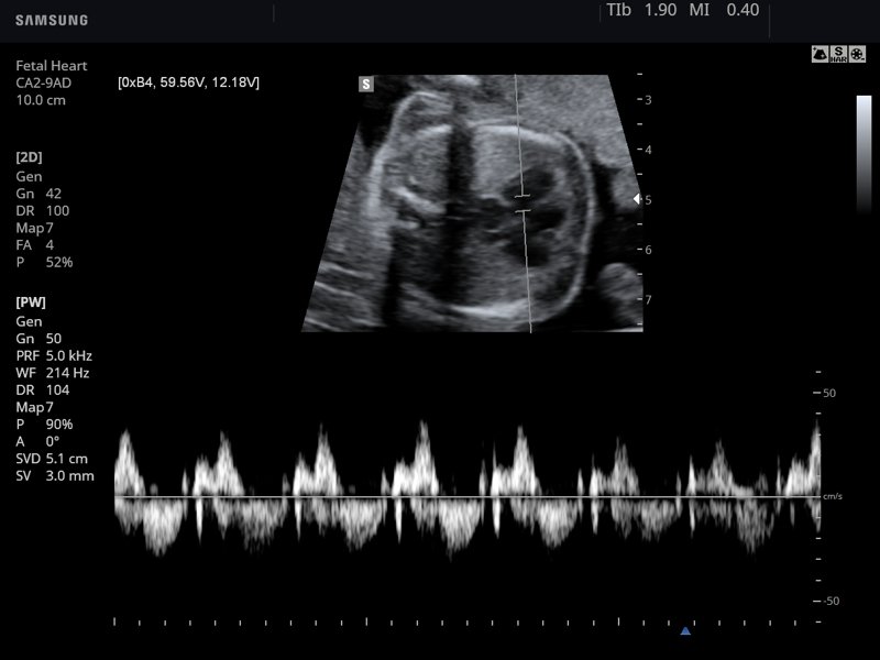 Сердце плода, PW доплер (эхограмма №782)