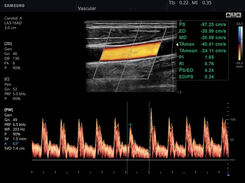 Общая сонная артерия, CFM и PW (эхограмма №793)